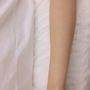 鄭州屈小麗醫(yī)療整形醫(yī)院醫(yī)生劉丹做手臂脫毛怎么樣？附手臂脫毛案例