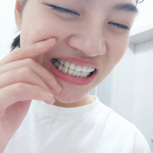 廈門拜博口腔醫(yī)院醫(yī)生張忠做牙齒隱形矯正怎么樣？附案例效果對比圖