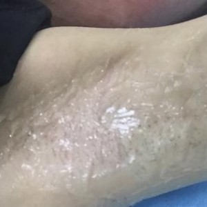 廈門張銘整醫(yī)療整形醫(yī)生張小玲做激光脫腋毛怎么樣？附激光脫腋毛效果對(duì)比圖