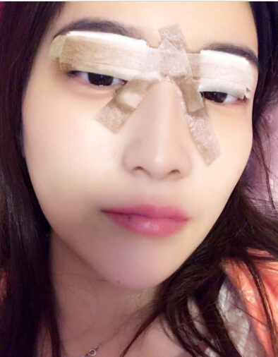 張家港唯恩整形醫(yī)院陳天杰醫(yī)生切開(kāi)雙眼皮案例效果對(duì)比圖