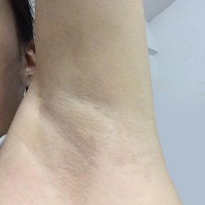 廈門張銘整醫(yī)療整形醫(yī)生張小玲做激光脫腋毛怎么樣？附激光脫腋毛效果對(duì)比圖