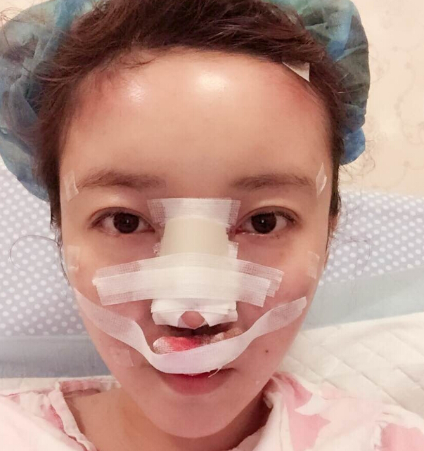 鄭州致美士整形醫(yī)院醫(yī)生閆江濤做鼻綜合+自體脂肪填充+吸脂案例效果對比圖