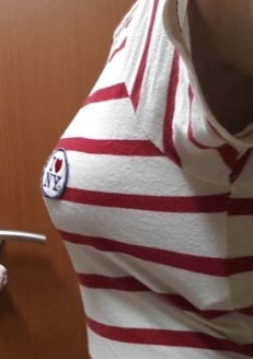 廣州基立嘉韓醫(yī)學整形醫(yī)院醫(yī)生劉朝忠做假體隆胸怎么樣？附案例效果對比圖