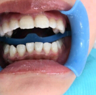 洛陽友好口腔醫(yī)院醫(yī)生楊愛芳做牙齒冷光美白怎么樣？附案例效果圖