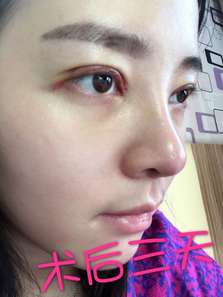 北京京韓整形醫(yī)生王義山做埋線雙眼皮怎么樣？附案例效果對比圖