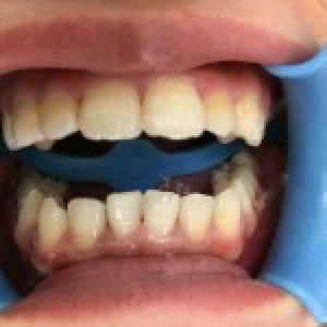 洛陽友好口腔醫(yī)院醫(yī)生楊愛芳做牙齒冷光美白怎么樣？附案例效果圖