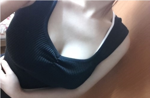 廣州基立嘉韓醫(yī)學整形醫(yī)院醫(yī)生劉朝忠做假體隆胸怎么樣？附案例效果對比圖