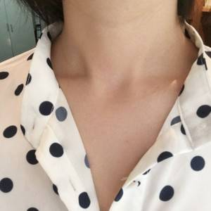 上海名媛醫(yī)療整形醫(yī)生閆嬌君做嗨體去頸紋效果怎么樣？附案例效果圖