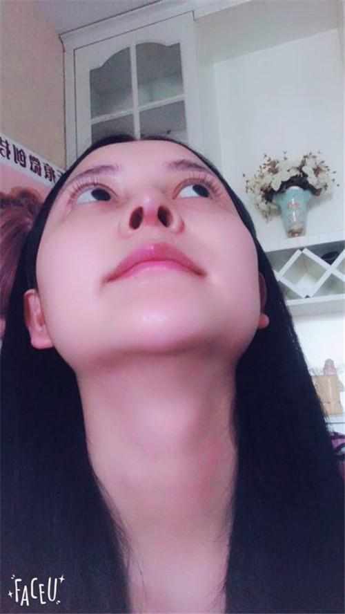 鄭州華領醫(yī)療美容醫(yī)院醫(yī)生張永濤做硅膠假體隆鼻怎么樣？附案例效果對比圖