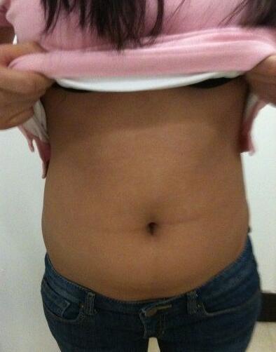 安徽韓美整形醫(yī)院醫(yī)生金壽信做水動(dòng)力吸脂怎么樣？附案例效果對比圖