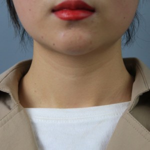 上海名媛醫(yī)療整形醫(yī)生閆嬌君做嗨體去頸紋效果怎么樣？附案例效果圖