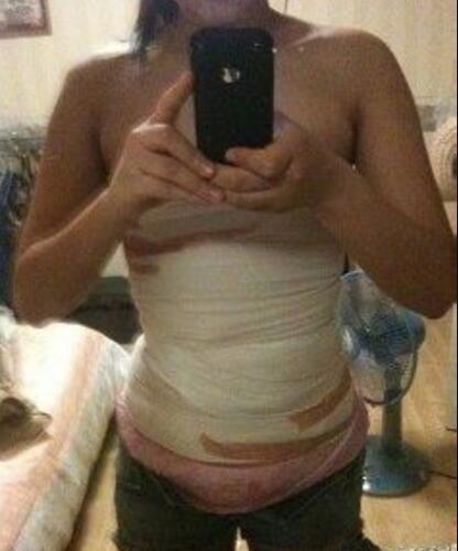 安徽韓美整形醫(yī)院醫(yī)生金壽信做水動(dòng)力吸脂怎么樣？附案例效果對比圖