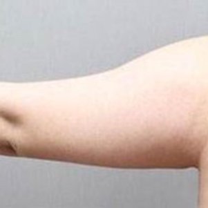 岳陽愛思特醫(yī)療美容醫(yī)院醫(yī)生王福生做手臂吸脂怎么樣？附案例效果圖