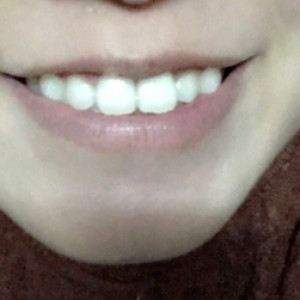 洛陽(yáng)友好口腔醫(yī)院醫(yī)生楊愛(ài)芳做牙齒冷光美白怎么樣？附案例效果圖