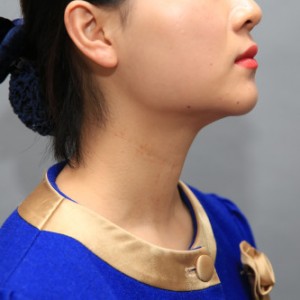 上海名媛醫(yī)療整形醫(yī)生閆嬌君做嗨體去頸紋效果怎么樣？附案例效果圖