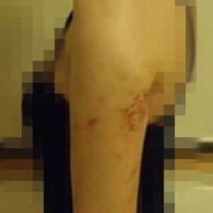 岳陽愛思特醫(yī)療美容醫(yī)院醫(yī)生王福生做手臂吸脂怎么樣？附案例效果圖