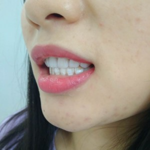 洛陽(yáng)友好口腔醫(yī)院醫(yī)生李新然做牙貼面怎么樣？附案例效果圖