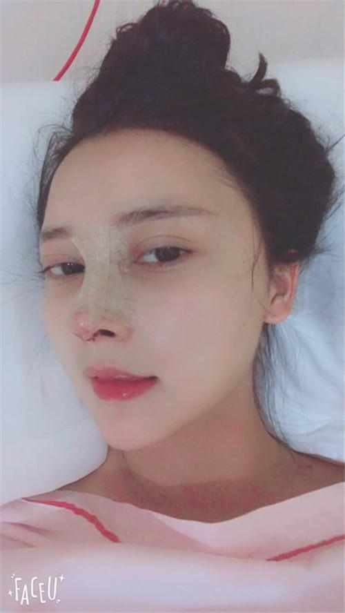 鄭州華領醫(yī)療美容醫(yī)院醫(yī)生張永濤做硅膠假體隆鼻怎么樣？附案例效果對比圖