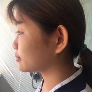 北京京民醫(yī)院整形外科醫(yī)生李鴻儒做硅膠隆鼻怎么樣？附案例效果圖