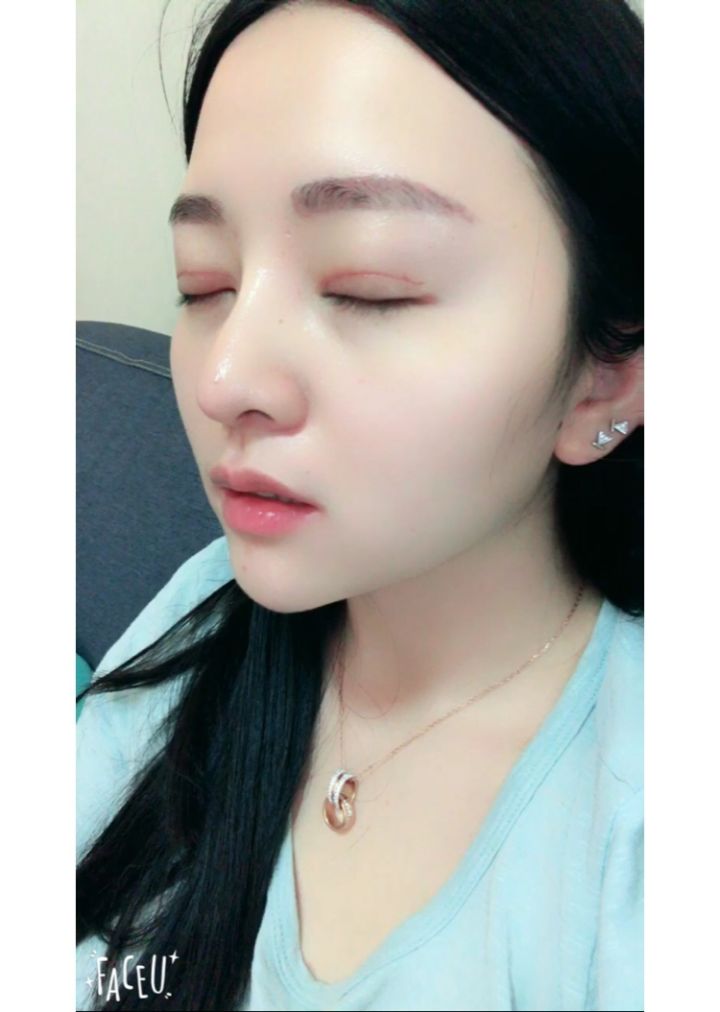 北京京韓整形醫(yī)生王義山做埋線雙眼皮怎么樣？附案例效果對比圖