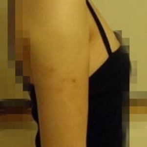 岳陽愛思特醫(yī)療美容醫(yī)院醫(yī)生王福生做手臂吸脂怎么樣？附案例效果圖