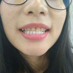 洛陽(yáng)友好口腔醫(yī)院醫(yī)生李新然做牙貼面怎么樣？附案例效果圖