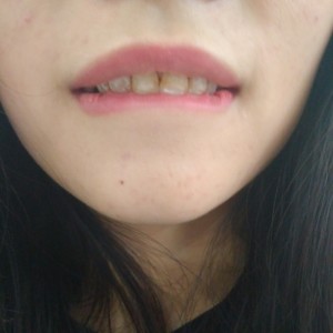 黔西南興義京州口腔醫(yī)院醫(yī)生徐勇做牙貼面怎么樣？附案例效果對(duì)比圖