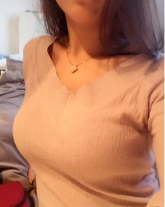 東莞韓美整形醫(yī)院醫(yī)生黃玉潔做假體隆胸怎么樣？附案例效果圖