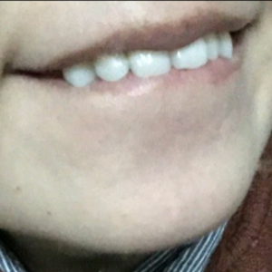 洛陽友好口腔醫(yī)院醫(yī)生楊愛芳做牙齒冷光美白怎么樣？附案例效果圖