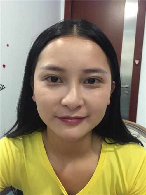 鄭州華領醫(yī)療美容醫(yī)院醫(yī)生張永濤做硅膠假體隆鼻怎么樣？附案例效果對比圖