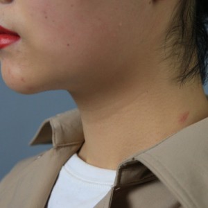 上海名媛醫(yī)療整形醫(yī)生閆嬌君做嗨體去頸紋效果怎么樣？附案例效果圖
