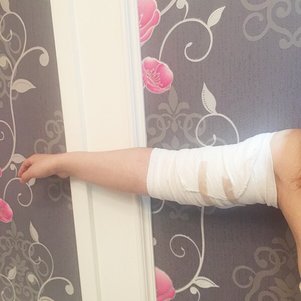 岳陽愛思特醫(yī)療美容醫(yī)院醫(yī)生王福生做手臂吸脂怎么樣？附案例效果圖