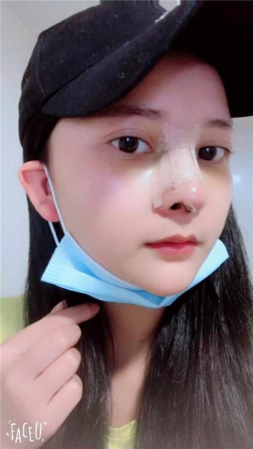 鄭州華領醫(yī)療美容醫(yī)院醫(yī)生張永濤做硅膠假體隆鼻怎么樣？附案例效果對比圖