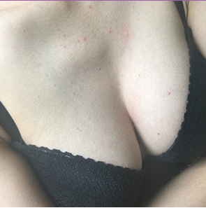 昆山百達(dá)麗醫(yī)療美容門診部醫(yī)生周嬡做自體脂肪隆胸怎么樣？附案例效果對比圖