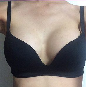 昆山百達(dá)麗醫(yī)療美容門診部醫(yī)生周嬡做自體脂肪隆胸怎么樣？附案例效果對比圖