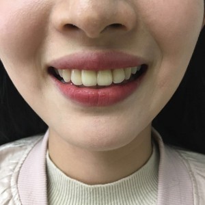 上?？仆呖谇会t(yī)院醫(yī)生鄧建儒做牙齒冷光美白怎么樣？附案例效果對(duì)比圖