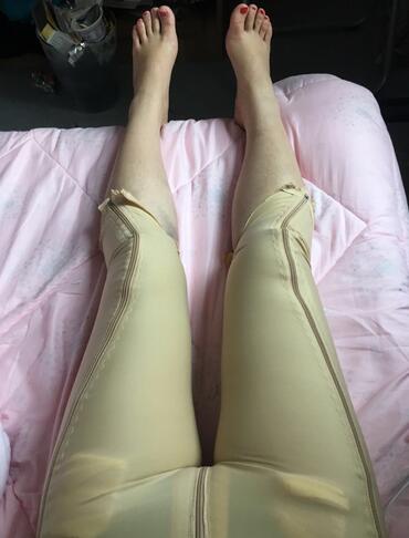上海保加醫(yī)療美容門診部做大腿吸脂怎么樣？附楊勇醫(yī)生案例效果對(duì)比圖