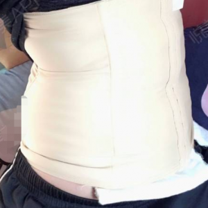 北京可思美整形醫(yī)院醫(yī)生斯勤做腰腹吸脂怎么樣？附案例效果對比圖