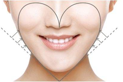 淄博壹美整形醫(yī)院下頜角整形