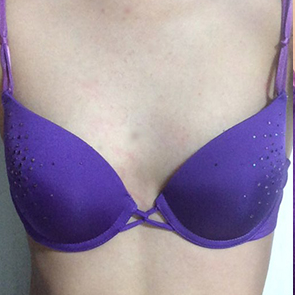 昆山百達(dá)麗醫(yī)療美容門診部醫(yī)生周嬡做自體脂肪隆胸怎么樣？附案例效果對比圖