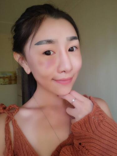 貴陽泰康樂醫(yī)院整形美容科醫(yī)生陳璐做自體脂肪全臉填充效果怎么樣？