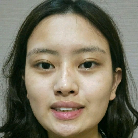 廣州愛來整形醫(yī)院醫(yī)生肖大衛(wèi)做激光點(diǎn)痣怎么樣？附案例效果對(duì)比圖