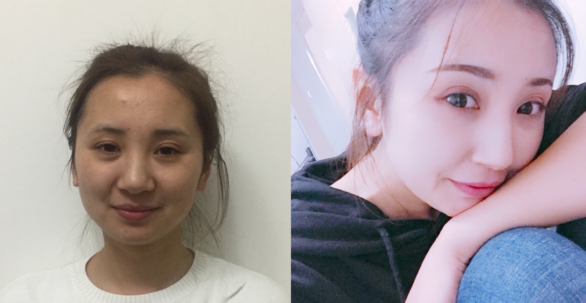 貴陽藝齡醫(yī)療美容門診部醫(yī)生李章做隆鼻手術(shù)怎么樣？附案例效果對比圖