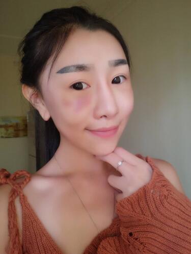 貴陽泰康樂醫(yī)院整形美容科醫(yī)生陳璐做自體脂肪全臉填充效果怎么樣？