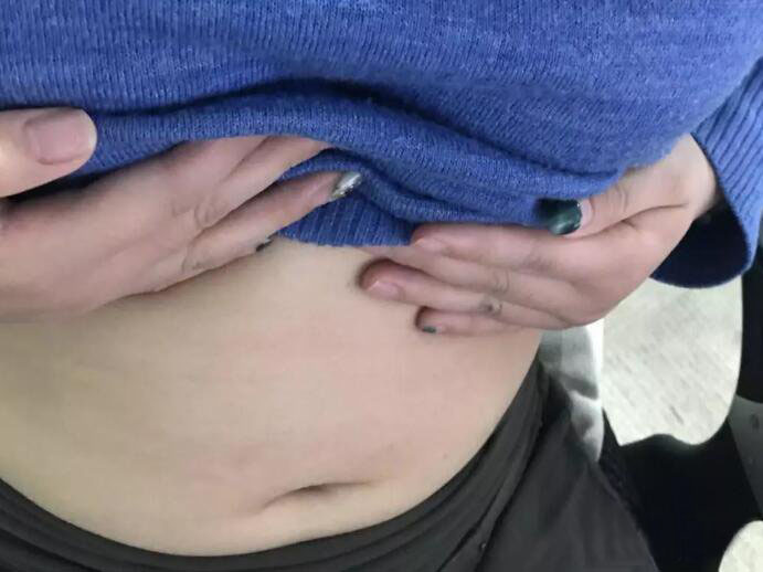 廣州尚美善造美容醫(yī)院醫(yī)生邵方做水動力吸脂怎么樣？附案例效果圖