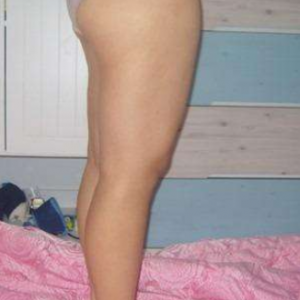 長沙真愛整形美容醫(yī)院醫(yī)生陳詠玲做大腿吸脂效果怎么樣？