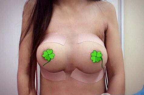 海南伊佳醫(yī)療美容醫(yī)院醫(yī)生涂陽(yáng)君做假體隆胸怎么樣？附案例效果對(duì)比圖