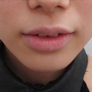 蚌埠韓美美萊整形醫(yī)院醫(yī)生張濤做玻尿酸墊下巴怎么樣？來看案例效果圖