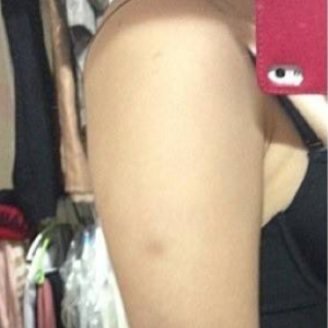 長沙柒和醫(yī)療整形醫(yī)生鐘滔做手臂吸脂怎么樣？附案例效果對(duì)比圖