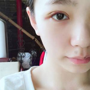 鄭州安格潤整形醫(yī)生楊曉紅做雙眼皮手術(shù)怎么樣？附案例效果圖